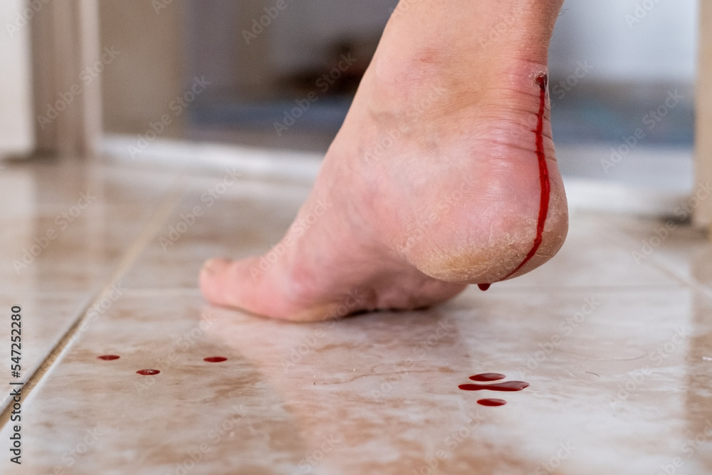 Man's heel with painful bloody callus. The problem of new uncomfortable shoes. Man's heel with painful bloody callus. The problem of new uncomfortable shoes.