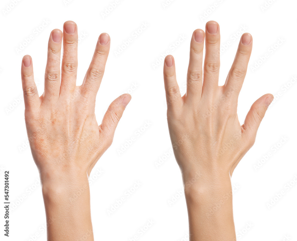 Collage with photos of woman showing hands with dry and moisturized skin on white background, closeup Collage with photos of woman showing hands with dry and moisturized skin on white background, closeup