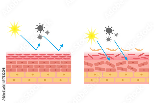 vector illustration of healthy and damaged skin anatomy comparison. epidermis and desmis of the skin. illustration for skin medical science and health.