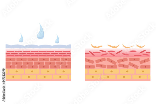 vector illustration of healthy and damaged skin anatomy comparison. hydrated and dry skin. skin with moisturizer. epidermis and desmis of the skin. illustration for skin medical science and health. photo