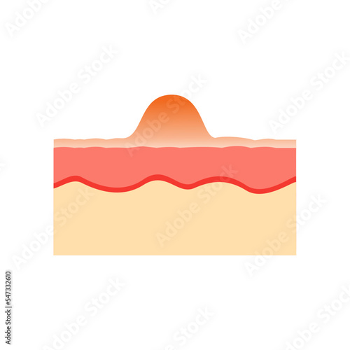 Vector illustration of human skin anatomy. Acne facial skin anatomy medical vector illustration. Dermis and epidermis of the skin.