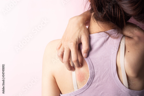 A woman with itching on her back. Irritation, insect bites photo