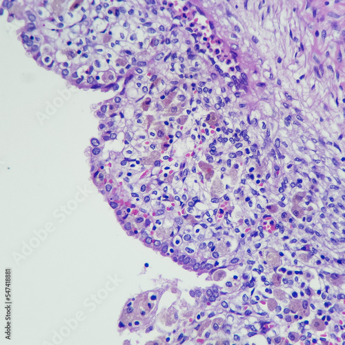 Camera photo of endometriotic cyst, showing endometrial mucosa with old hemorrhage, magnification 400x, photograph through a microscope
