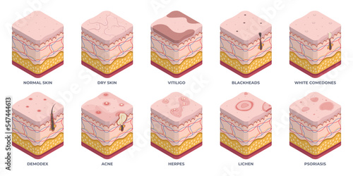 Isometric human skin types, 3d epidermis layers. Dermatology normal, oily and dry epidermis, skin structure problems, wrinkles, acne and rosacea flat vector illustration set. Epidermis layers photo