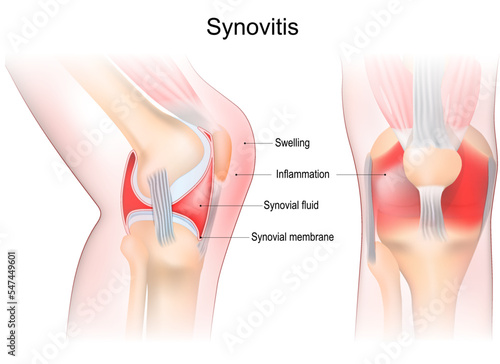 synovitis of a Knee. Frontal and side view of human knee joint photo