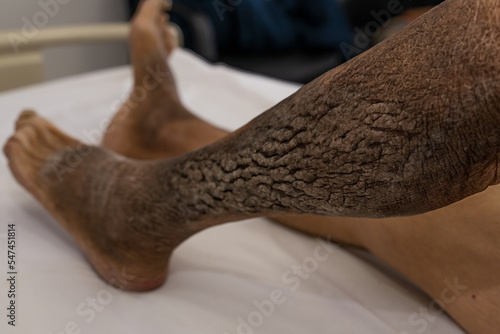 Senior female with Acantosis Nigricans on her leg. Medical themes photo