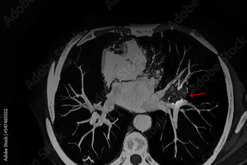 CAT Scan image pulmonary angiography showing lung adenocarcinoma with red arrow. Medical themes