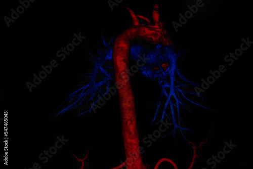 CAT Scan image pulmonary angiography showing lung adenocarcinoma. Medical themes