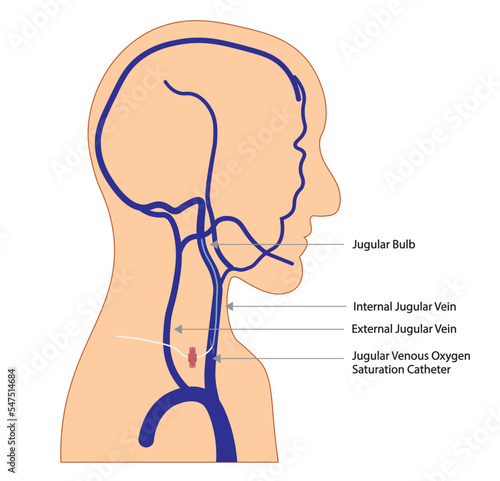 Men head and neck silhouette with venous vessels illustration and a Bulb jugular catheter placed