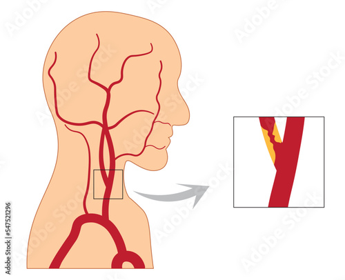 Men head and neck silhouette with arteries illustration. Carotid obstructed by a fat plaque.