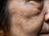 Wrinkles and loosening skin in the face of Chinese elder woman