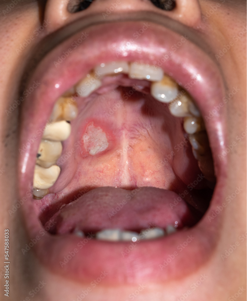 Ulcer On Tonsil