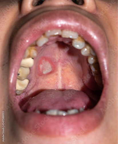 Fotografie Aphthous ulcer or stress ulcer in mouth of Asian patient.