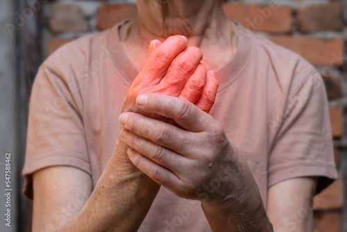 Hand joints inflammation. Concept of rheumatic arthritis, rheumatism, gout, joint swelling or arthralgia.