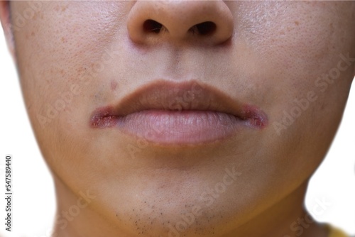 Angular stomatitis or angular cheilitis or perleche in asian man. Mouth ulcer. Common inflammatory condition caused by iron, zinc or B12 deficiency, or repetitive trauma. photo