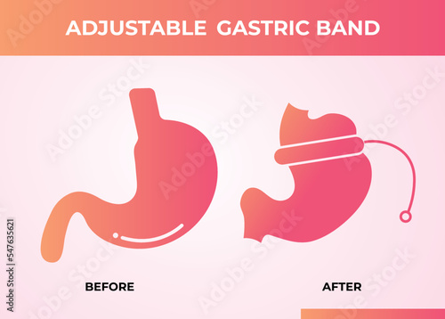 Illustration of Adjustable Gastric Band devise Weight Loss Surgery vector
