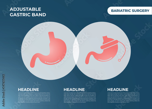 Illustration of Adjustable Gastric Band devise Weight Loss Surgery vector
