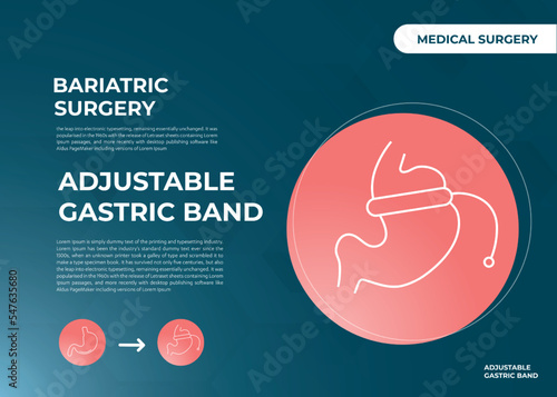 Illustration of Adjustable Gastric Band devise Weight Loss Surgery vector
