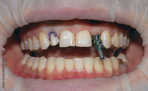 Smile with teeth prepared for ceramic veneer. Dental implant and ceramic crown