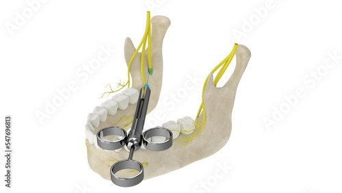 Mandibular arch with inferior alveolar nerve block. Types of dental anesthesia concept.  photo