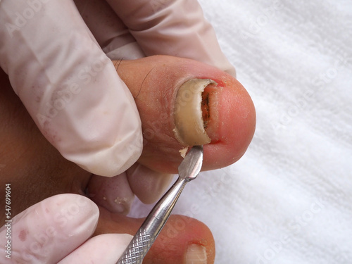 Leg with onycholysis. Medic removes the big toe nail photo