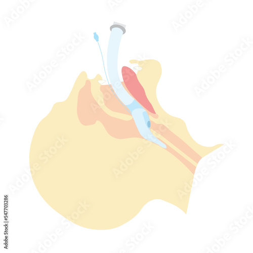 Intubation with laryngeal mask illustration. LMA positioning