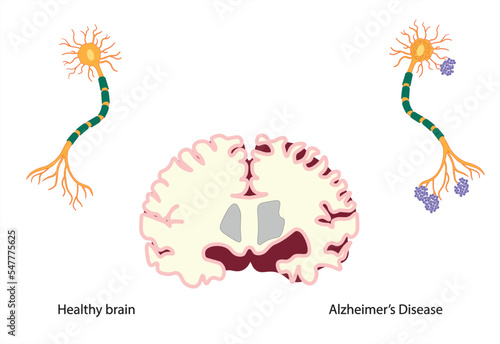 Brain divided in two showing at the left a healthy brain and neuron and in the right side a brain and a neuron affected by alzheimer's disease. 