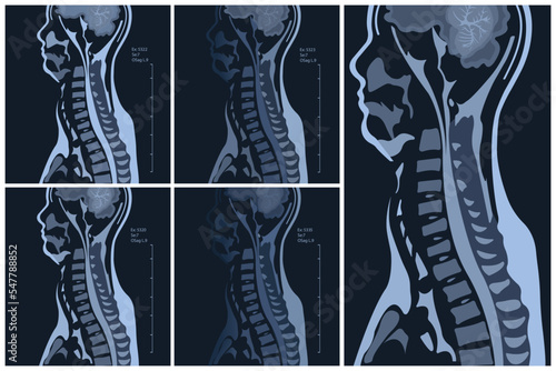 magnetic resonance image or MRI of the cervical spine in sagittal projection demonstrating cervical spondylosis and spinal cord compression. The disease causes neck pain and radiculopathy.
