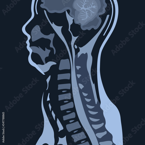 Magnetic resonance imaging of the cervical spine spine. Spondylosis and spinal cord compression.