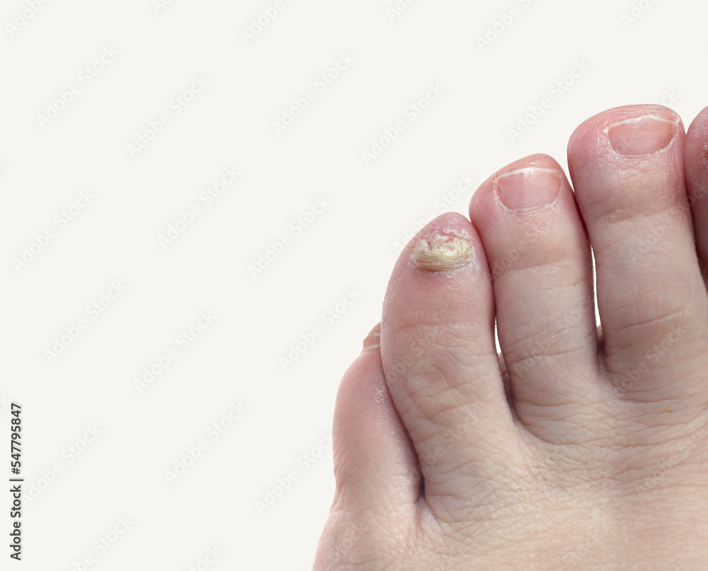 Home remedies for toenail fungus: Are they effective?