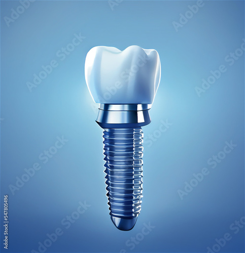 Dental implant