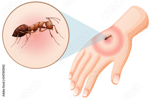 Ant bites sting on skin