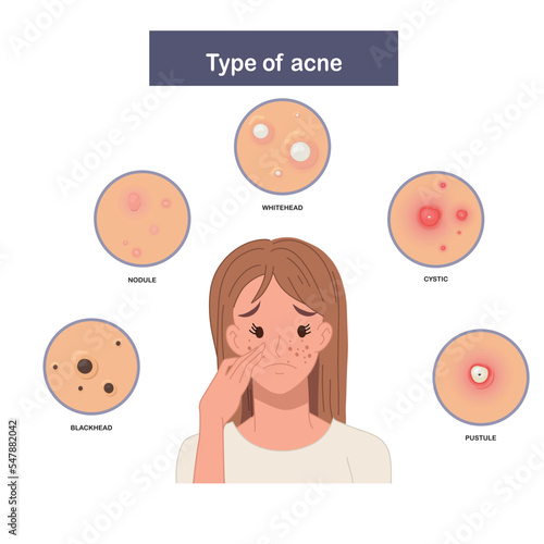 Infographic of Type of acne, sad and worried woman with acne. Flat vector illustration