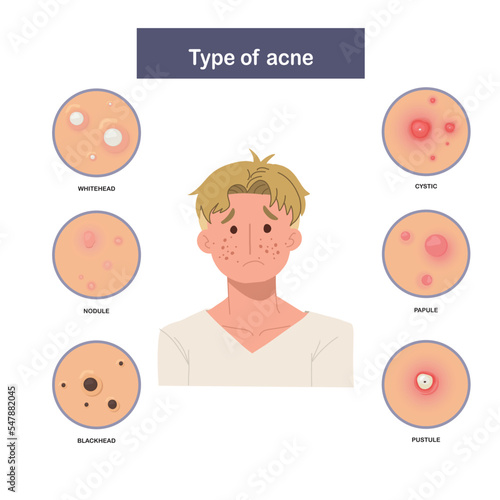 Infographic of Type of acne, sad and worried man with acne. Flat vector illustration