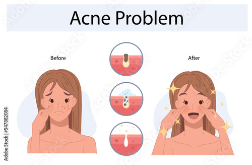 Upset woman with facial skin problem. infographic of acne disease and stages of treatment. Before and after. Vector illustration.v