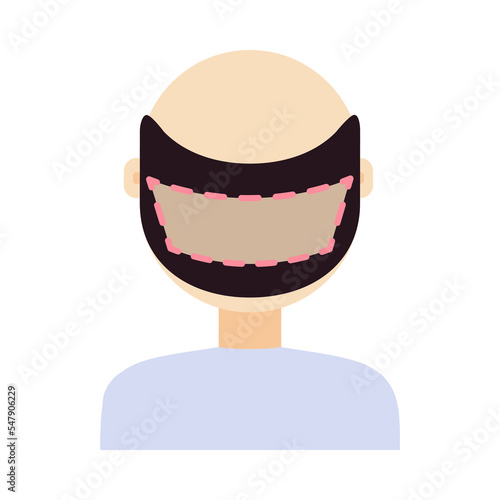 FUE hair transplant treatment of alopecia. Back view of a man at surgery. Male hair loss pattern. Medical infographics. Cartoon vector illustration.