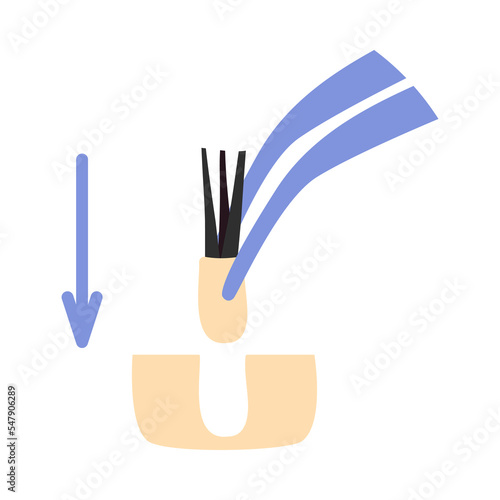 Hair transplant treatment forceps symbol. Surgical tweezers pulling out hair follicle. Alopecia medical procedure equipment tool. Hair loss diagnosis and transplantation concept. Vector illustration.