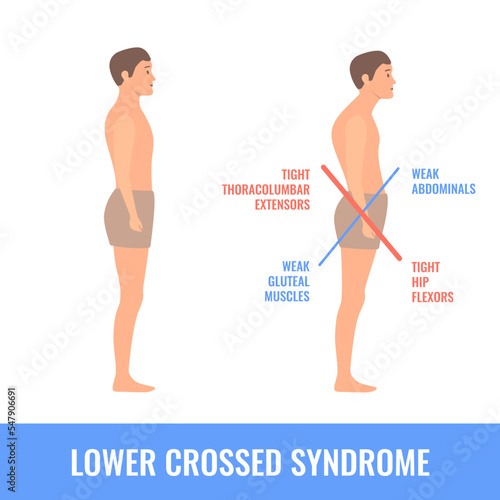 Lower crossed syndrome medical diagram. Crooked man with muscle strength imbalance. Weak and overactive pelvis muscles therapy. Incorrect spine curvature caused by bad posture. Vector illustration.