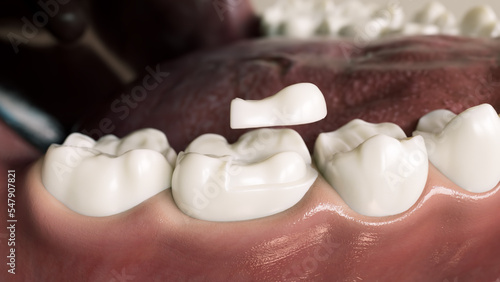 Obraz na plátně Ceramic Onlay quarter crown over a tooth- 3D Rendering