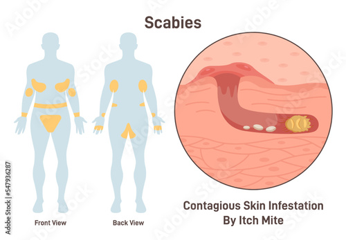 Scabies. Skin infestation with itch mite. Infected microscopic epidermis