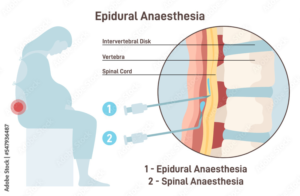 Epidural and spinal anesthesia. Labor anesthesia of pregnant woman - obrazy, fototapety, plakaty 
