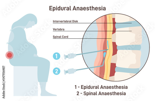 Epidural and spinal anesthesia. Labor anesthesia of pregnant woman