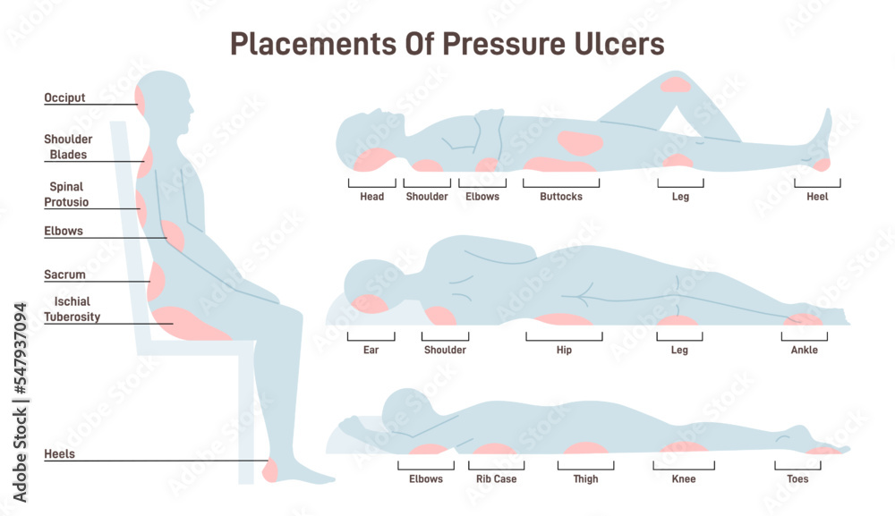 Pressure ulcers placements. Pressure sores areas on human body part