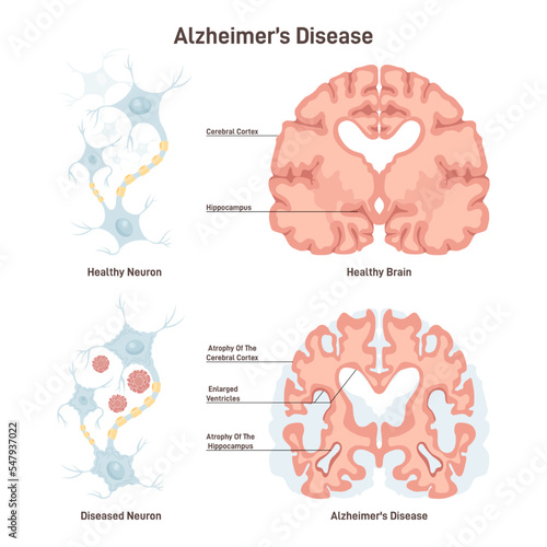 Alzheimer's disease. Human brain cross section, healthy and diseased