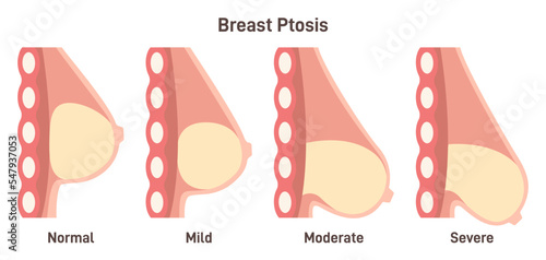 Woman breast ptosis. Stages of female breasts' sagging. Breast fat