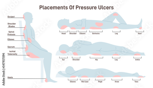Pressure ulcers placements. Pressure sores areas on human body part photo