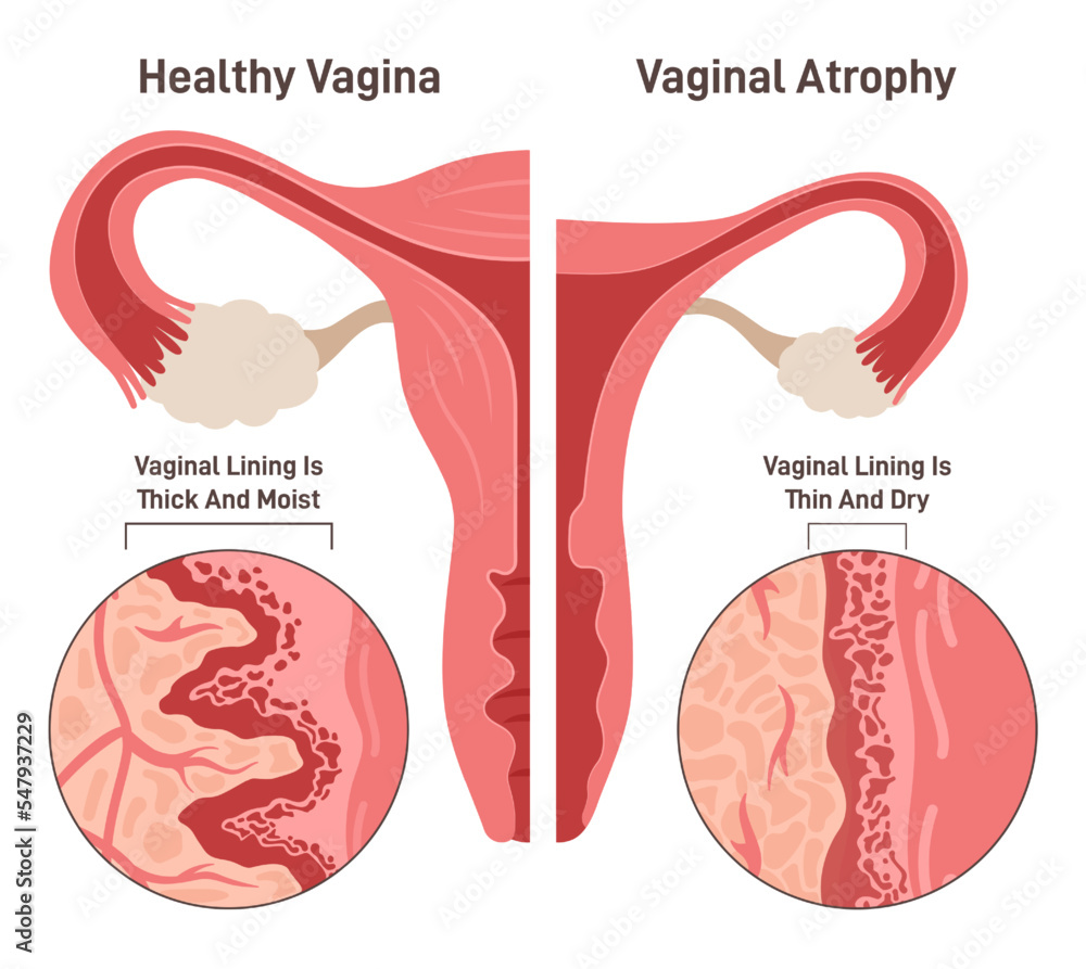 Vaginal Atrophy Images – Browse 45 Stock Photos, Vectors, and