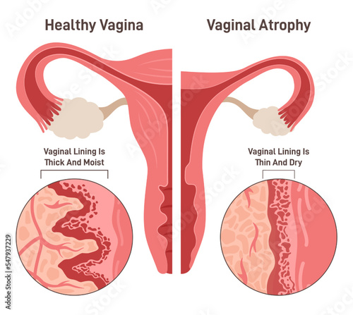 Fotografia Vaginal atrophy