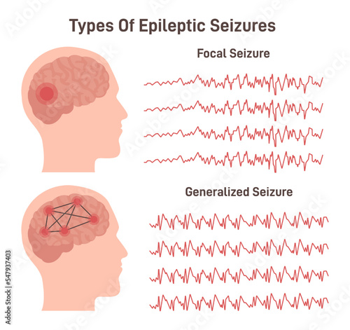 Types of epilepsy. Generalized and focal seizures. Human brain