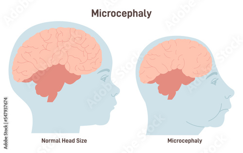 Microcephaly. Birth defect caused by Zika virus, medical condition